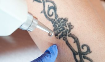 The Truth Behind Tattoo Removal