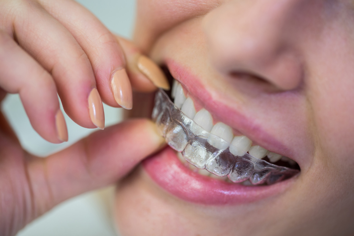 better alternative to Braces