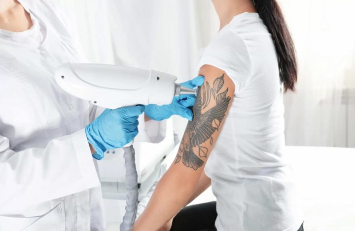 tattoo removal